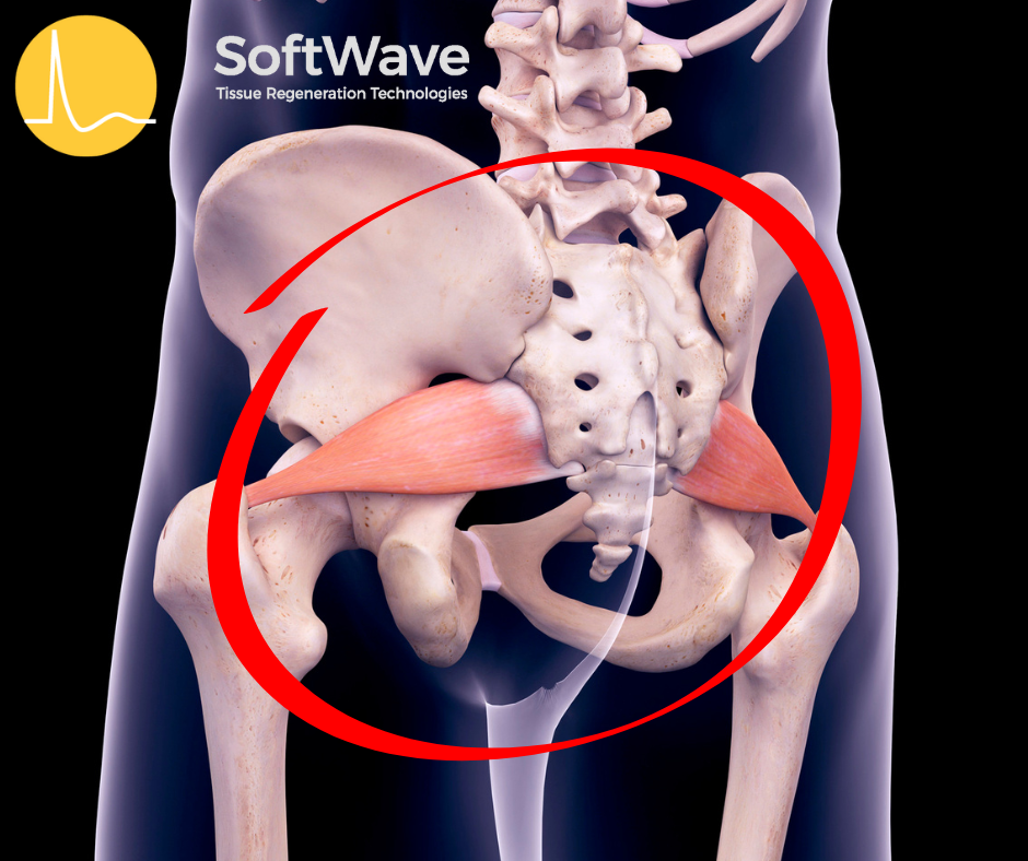 Navigating Sciatic Nerve Entrapment with Electrohydraulic Supersonic Acoustic Waves: A SoftWave Therapy Insight